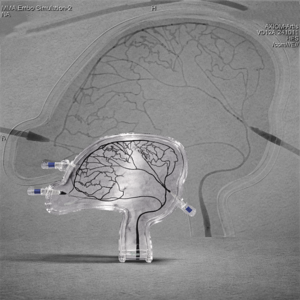 MMA Liquid Embolization Single-Use Model Type D